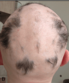 alopecia_hair_loss_b
